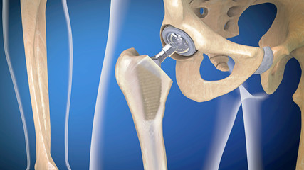 Med gadget Artificial Hip with hip joint surgery