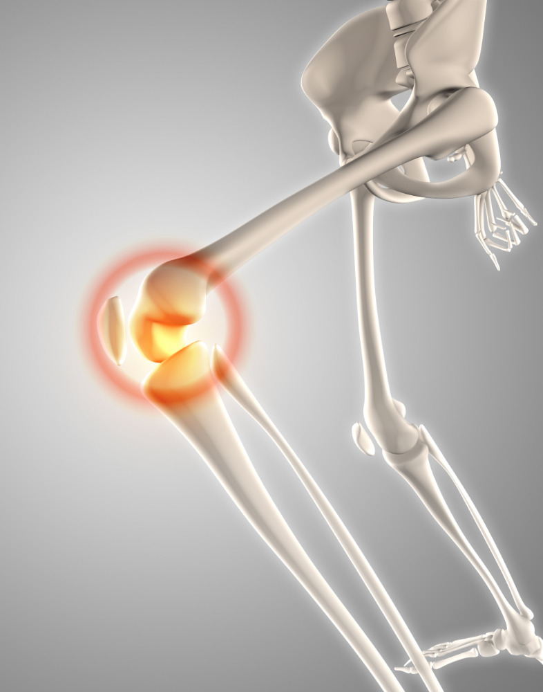 Benefits of Knee Replacement Surgery