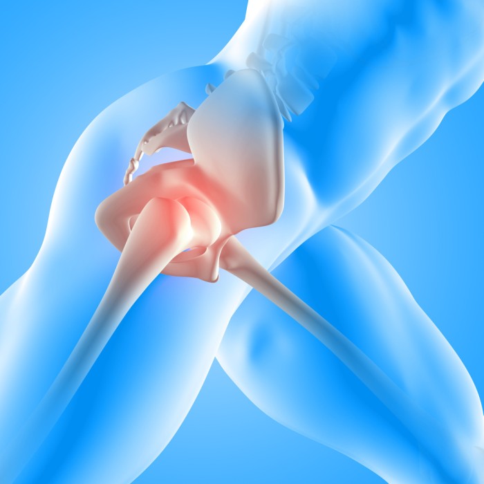 Hip Pain and How to do Hip Replacement Surgeyr