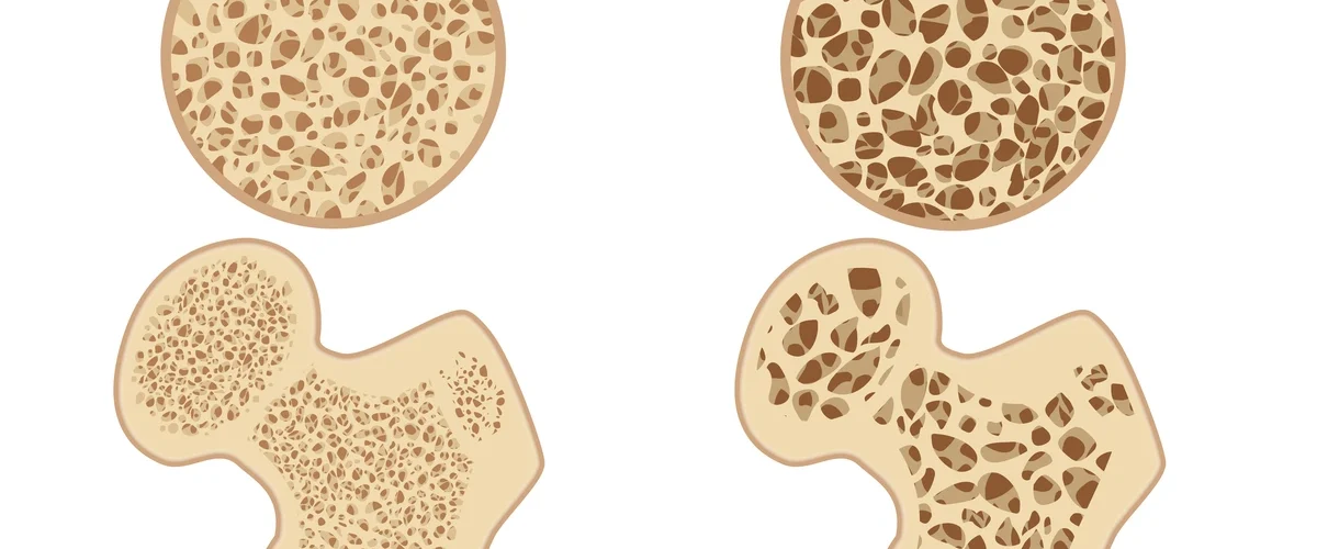 bone thinning caused by osteoporosis
